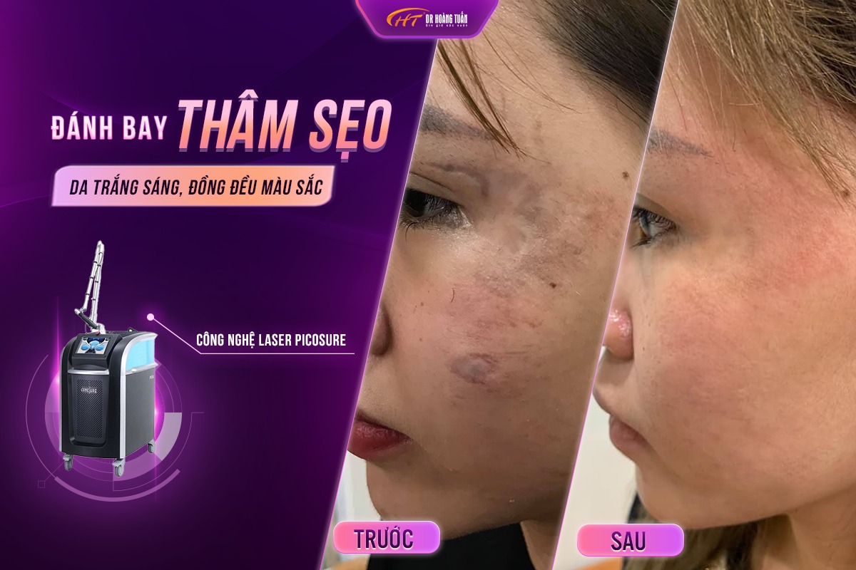 trị thâm bằng laser là gì